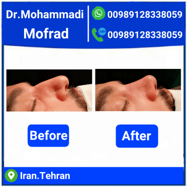 Nasal Cosmetic Surgery Dr. Amir Hossein Mohammadi Mofrad