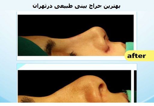 بهترین جراح بینی طبیعی در تهران