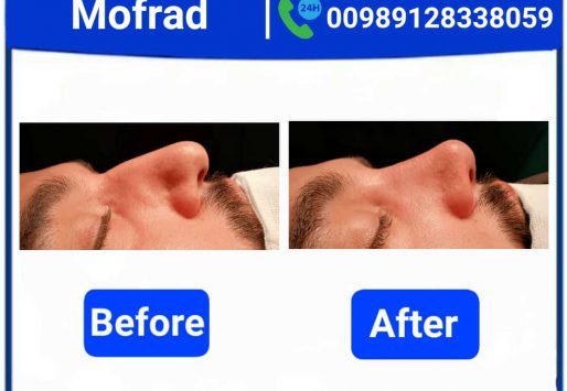 eyelid surgery (blepharoplasty) for a more youthful appearance