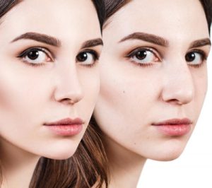 Price, Benefits and Possible Complications of Rhinoplasty